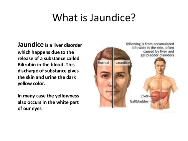 Jaundice